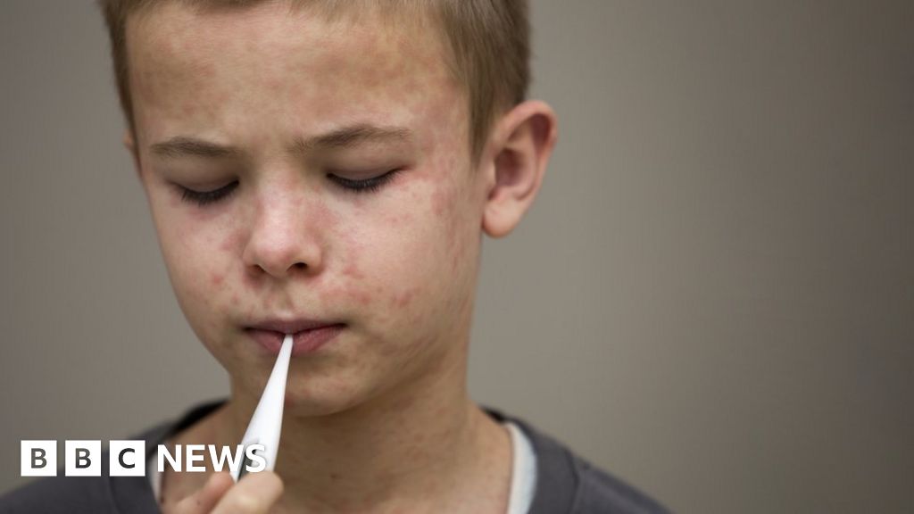 "Urgent Call for MMR Vaccine as Measles Outbreaks Threaten North America"