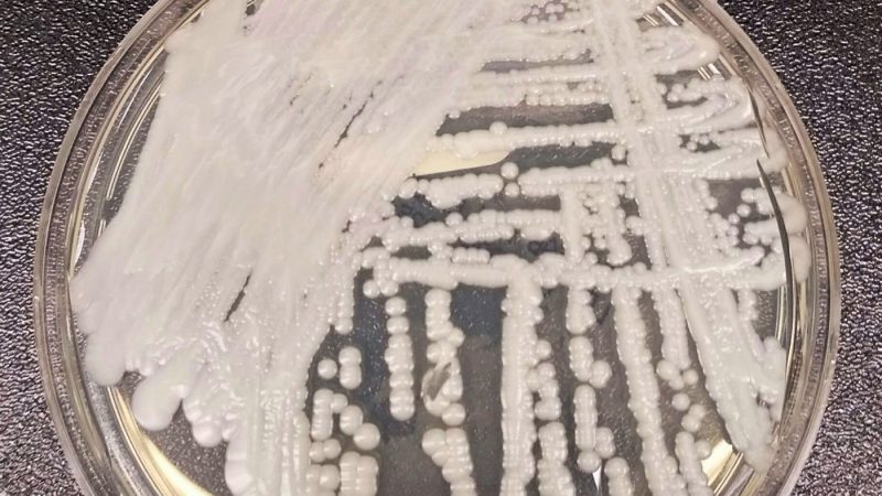 Featured image for Superbug Candida auris Spreading Across the US and Globally