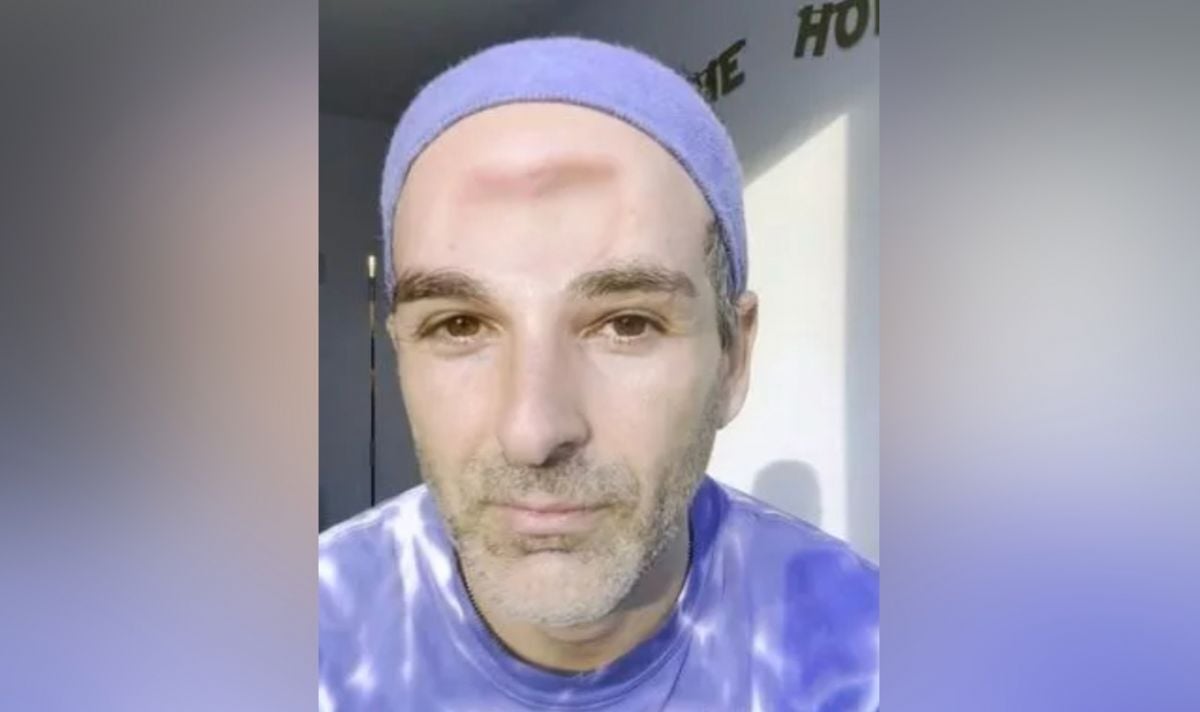 Featured image for Surviving Tumour Invasion: From Forehead Tumours to a Huge Dent