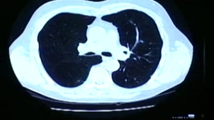 Featured image for Optimizing Lung Cancer Care: Guidelines, Screening, and Lifestyle Tips