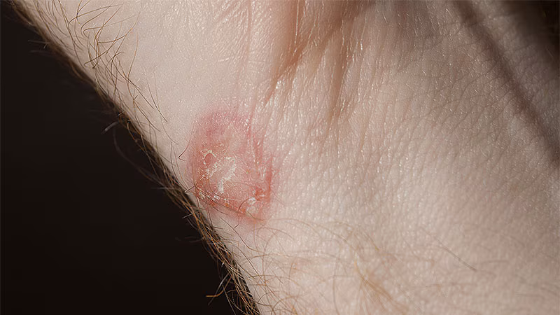 Featured image for New Fungal STI Detected in MSM Community