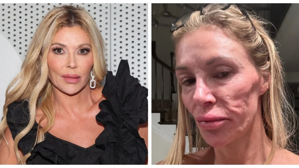 Featured image for Brandi Glanville Reveals Parasite Behind Dramatic Facial Changes