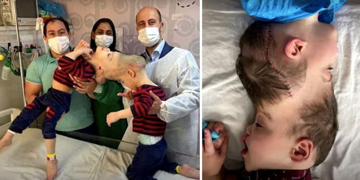 "Successful Separation of Conjoined Twins with Fused Brains After Virtual Reality Surgical Practice"