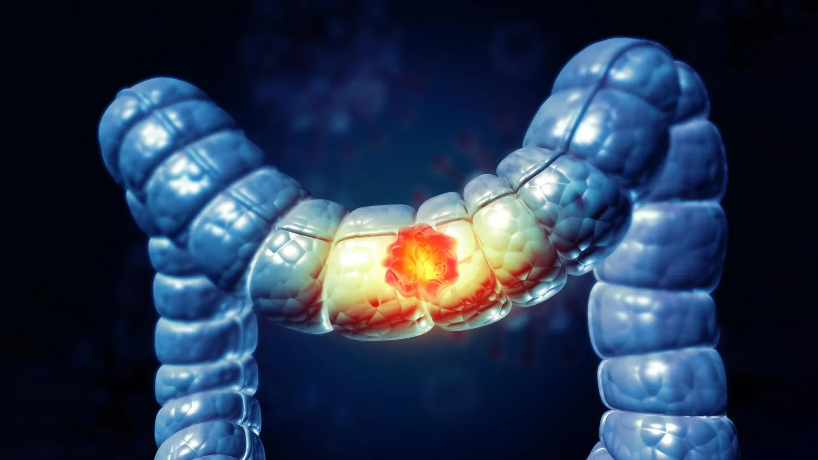 Americans largely unaware of processed meat's link to colon cancer, poll finds