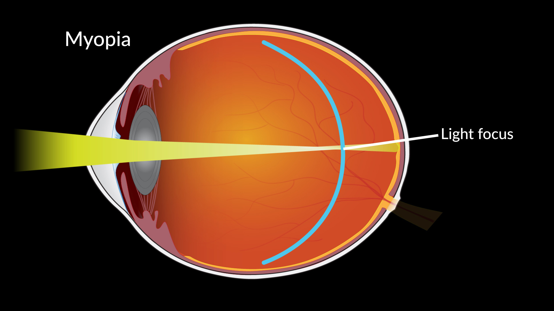 Featured image for Ineffective Low-Dose Eyedrops Fail to Slow Myopia Progression
