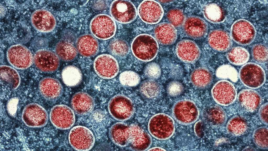 Milwaukee Resident Tests Positive for Mpox, Health Officials Urge Precautions