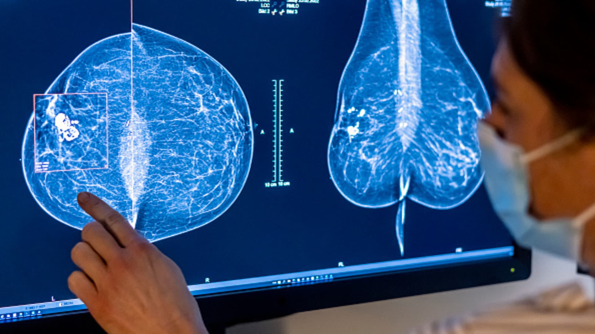 US panel recommends starting breast cancer screenings at age 40.