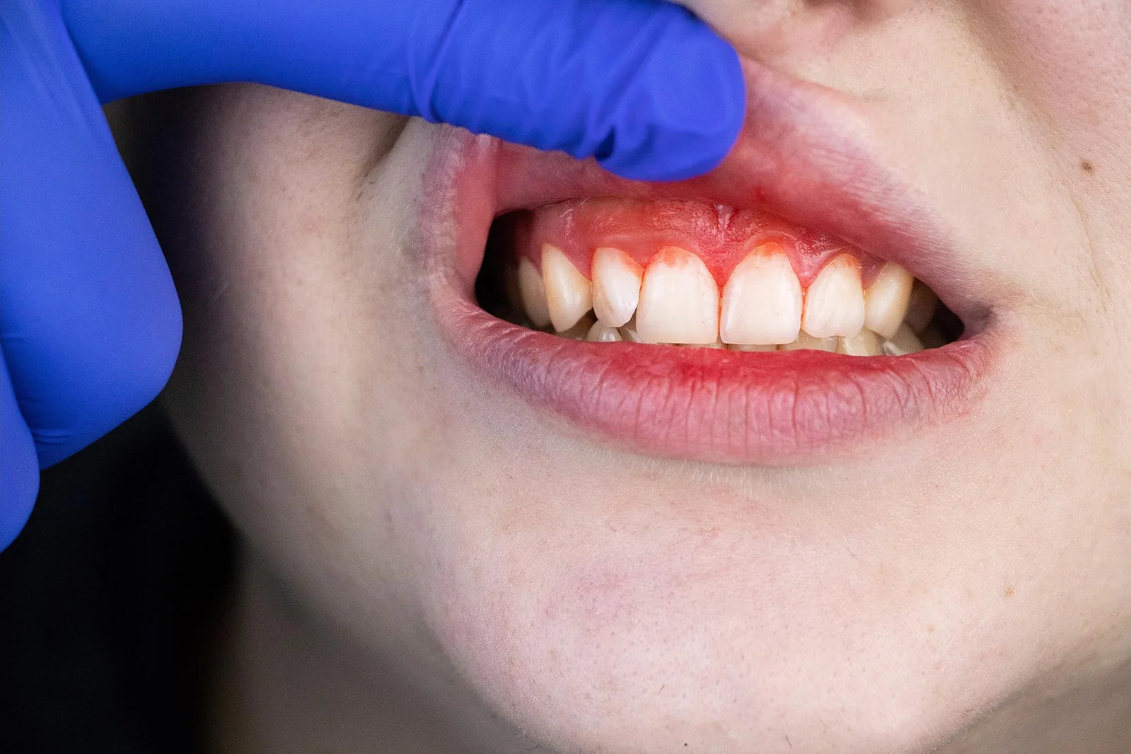 Featured image for Natural Plant Compound Offers Hope for Gum Disease Treatment