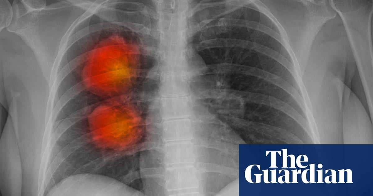 Revolutionary AI tool accurately detects cancer