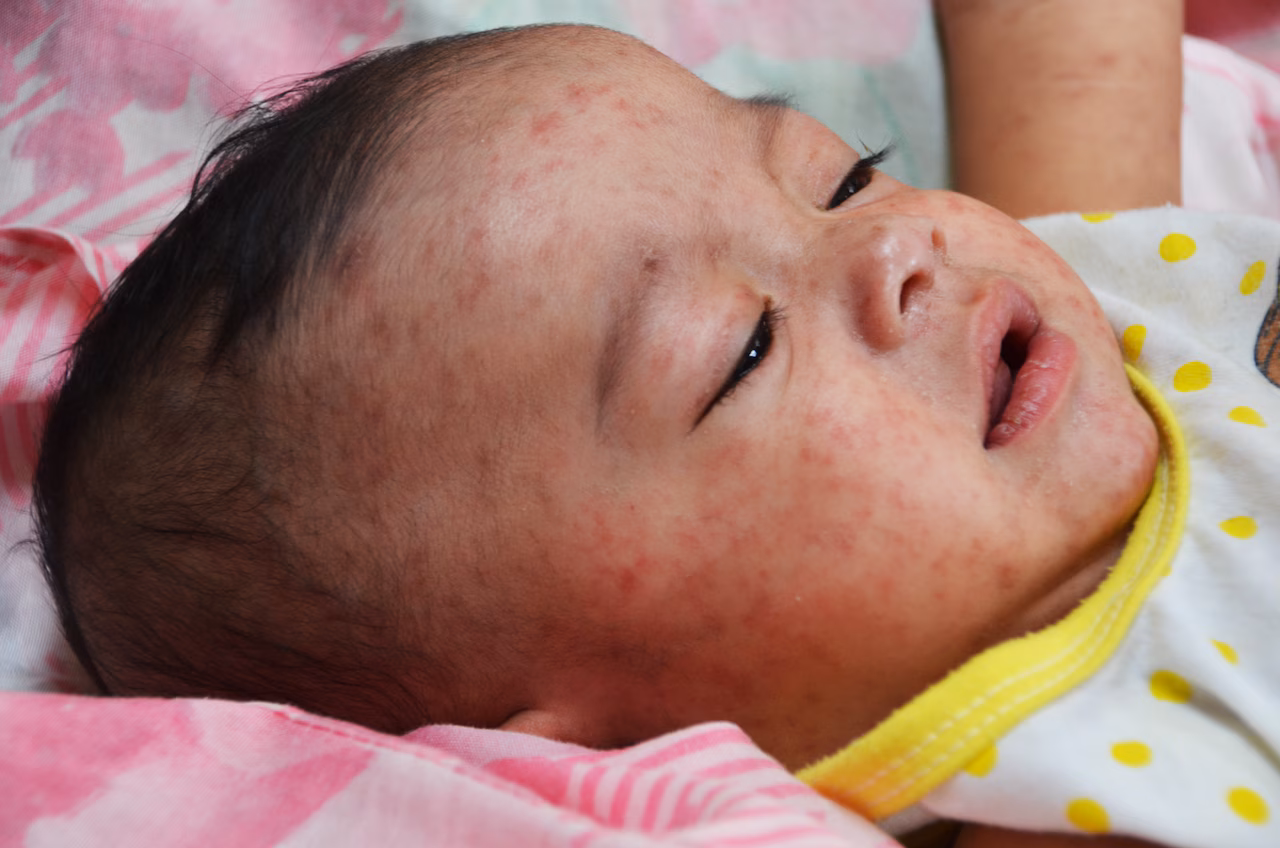 Measles Cases in the U.S. Reach 25-Year High Amid Outbreaks