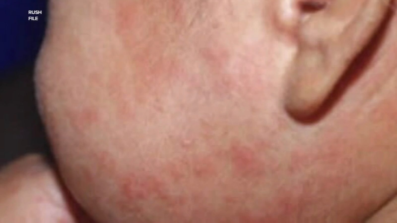 "Chicago Measles Outbreak: Cases Rise to 17, Prompts Vaccine Campaign"