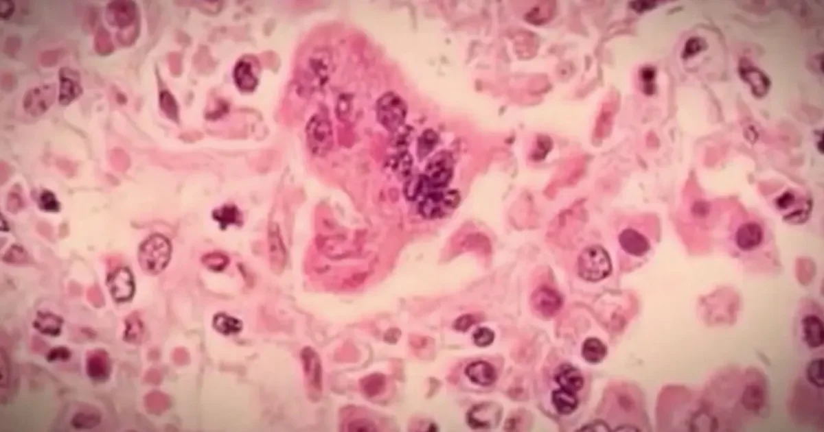 Minnesota weighs ending conscientious-objector exemption for MMR amid measles surge