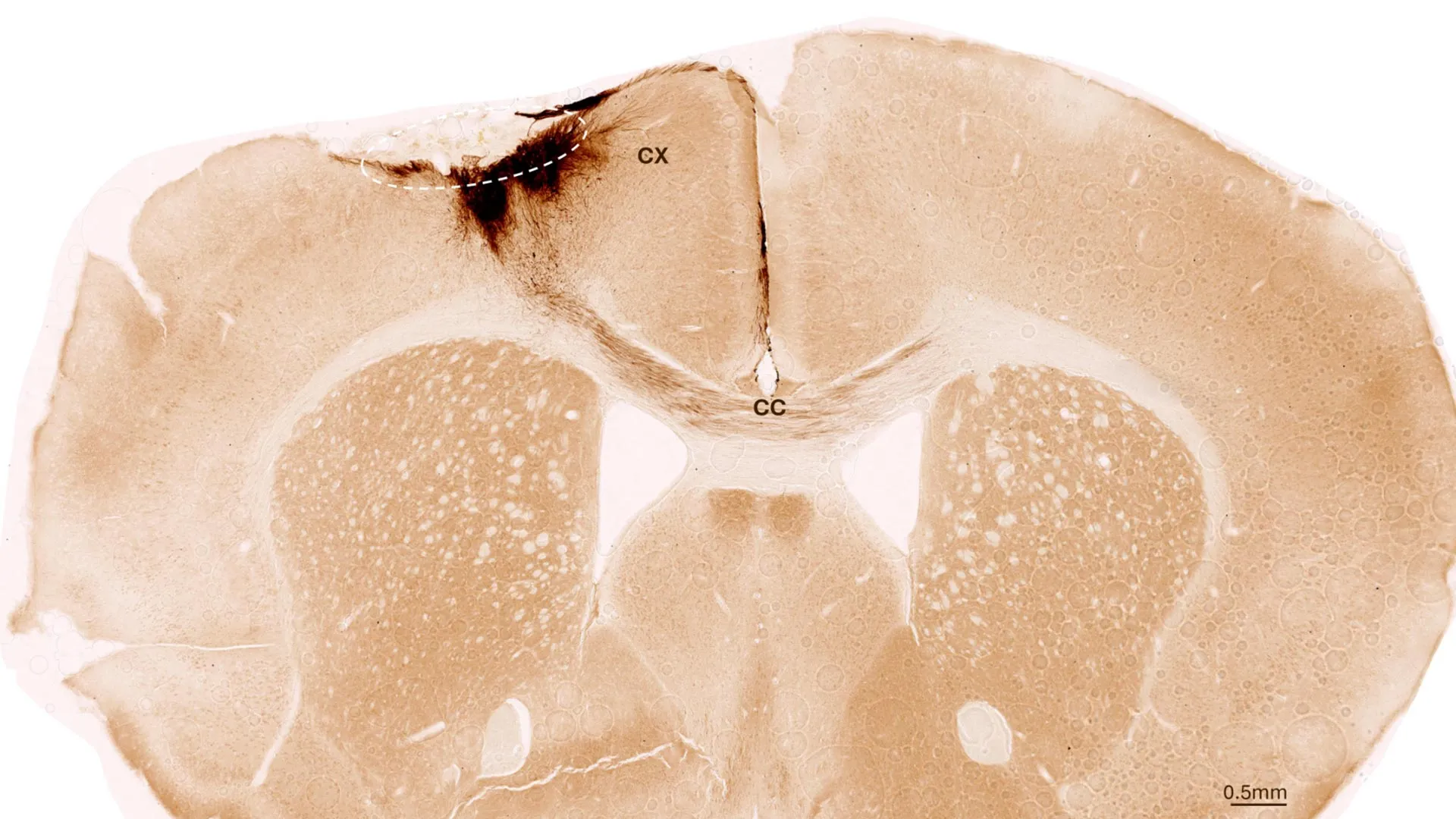 Featured image for Stem Cell Therapy Promotes Brain Repair and Recovery Post-Stroke