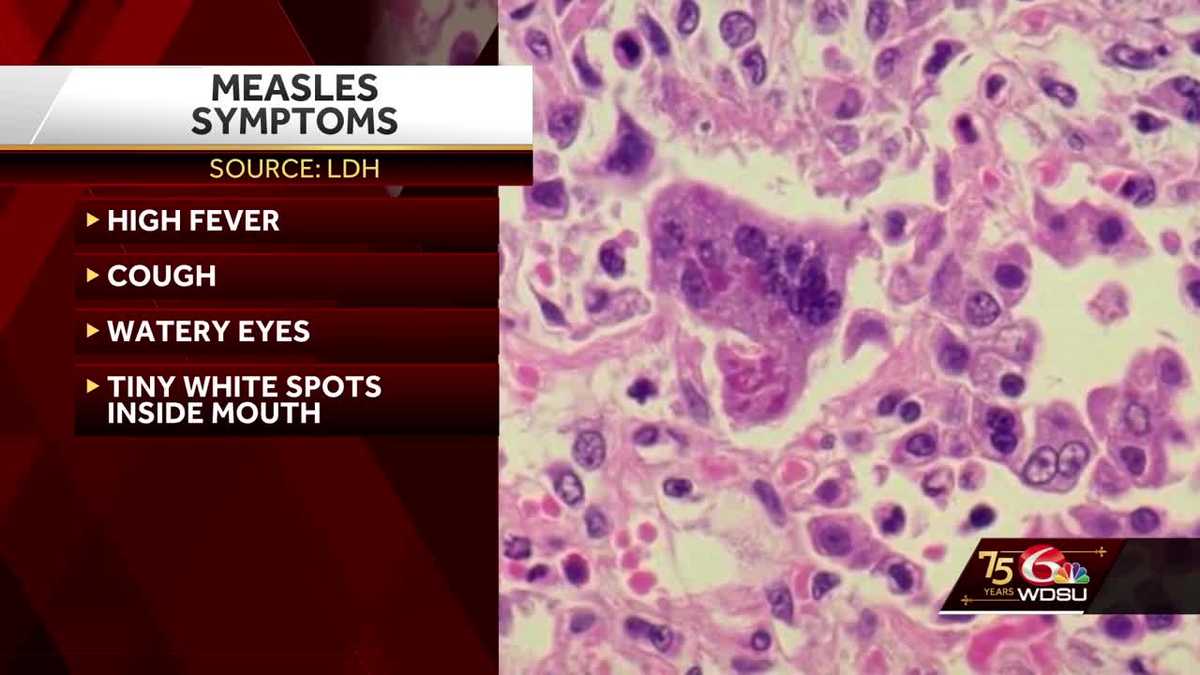 Measles Outbreak Hits New Orleans Area