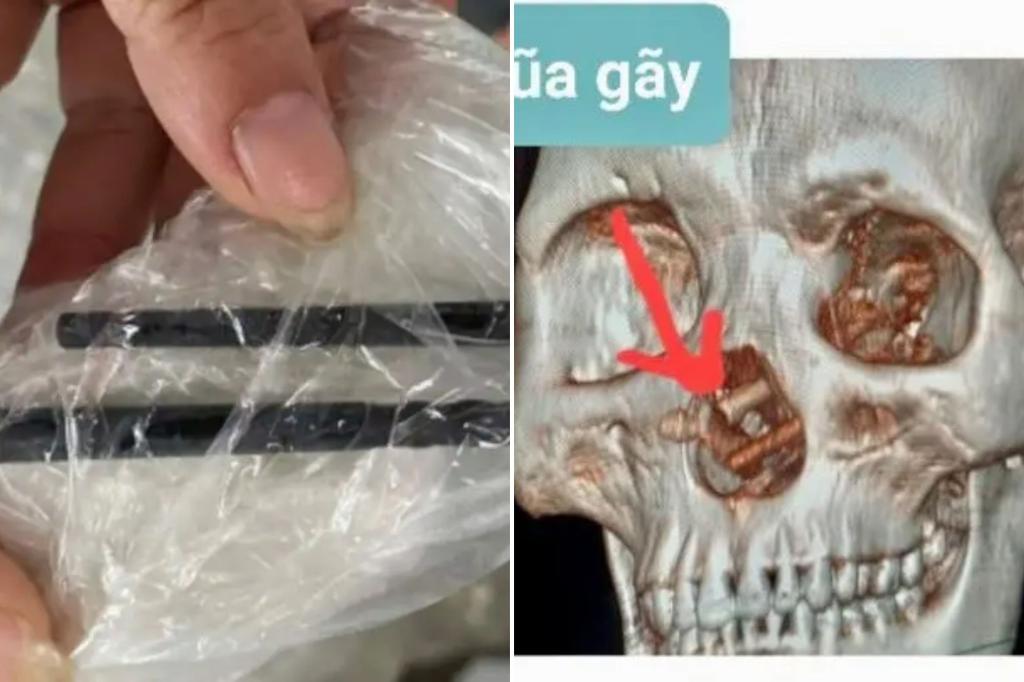 Featured image for Chopstick Mishap: Man's 5-Month Headache Mystery Solved