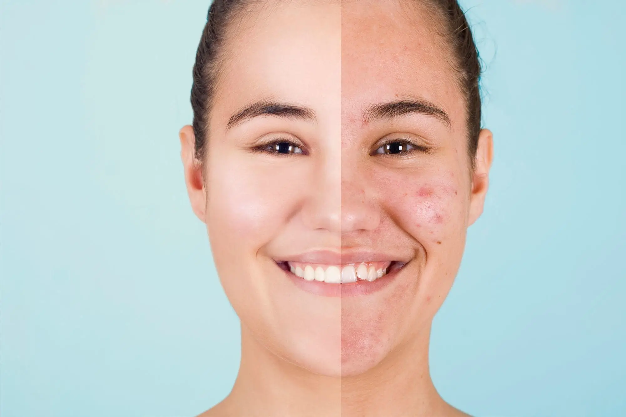 Featured image for "Breakthrough: Scientists Unveil Promising Acne Treatment"