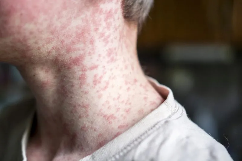 CDPHE Warns of Measles Exposure in Mesa County