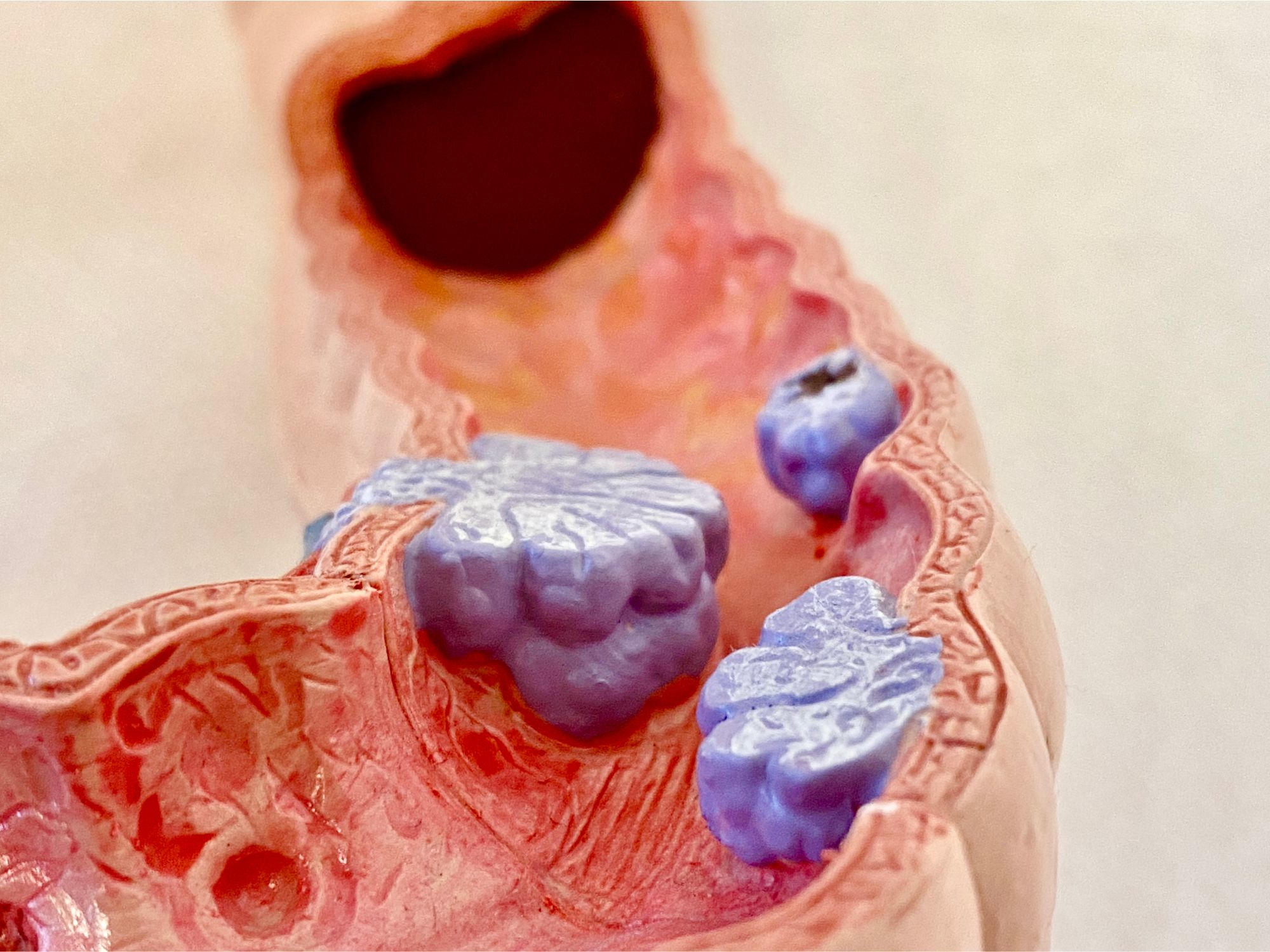 Featured image for Gut Microbiome Changes Linked to Colon Polyps, a Precursor to Cancer.