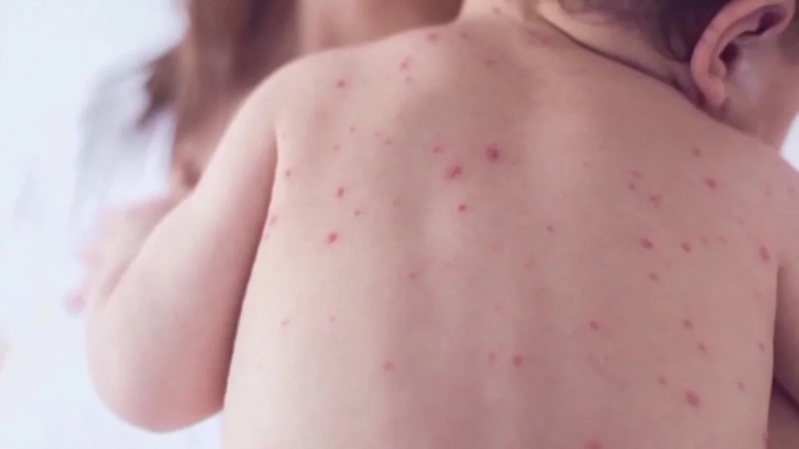 Maine records first measles case since 2019, prompts exposure alerts