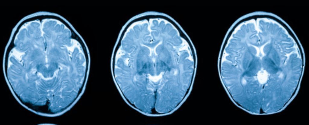 "Growing Brains: A Potential Solution to Dementia Risk?"