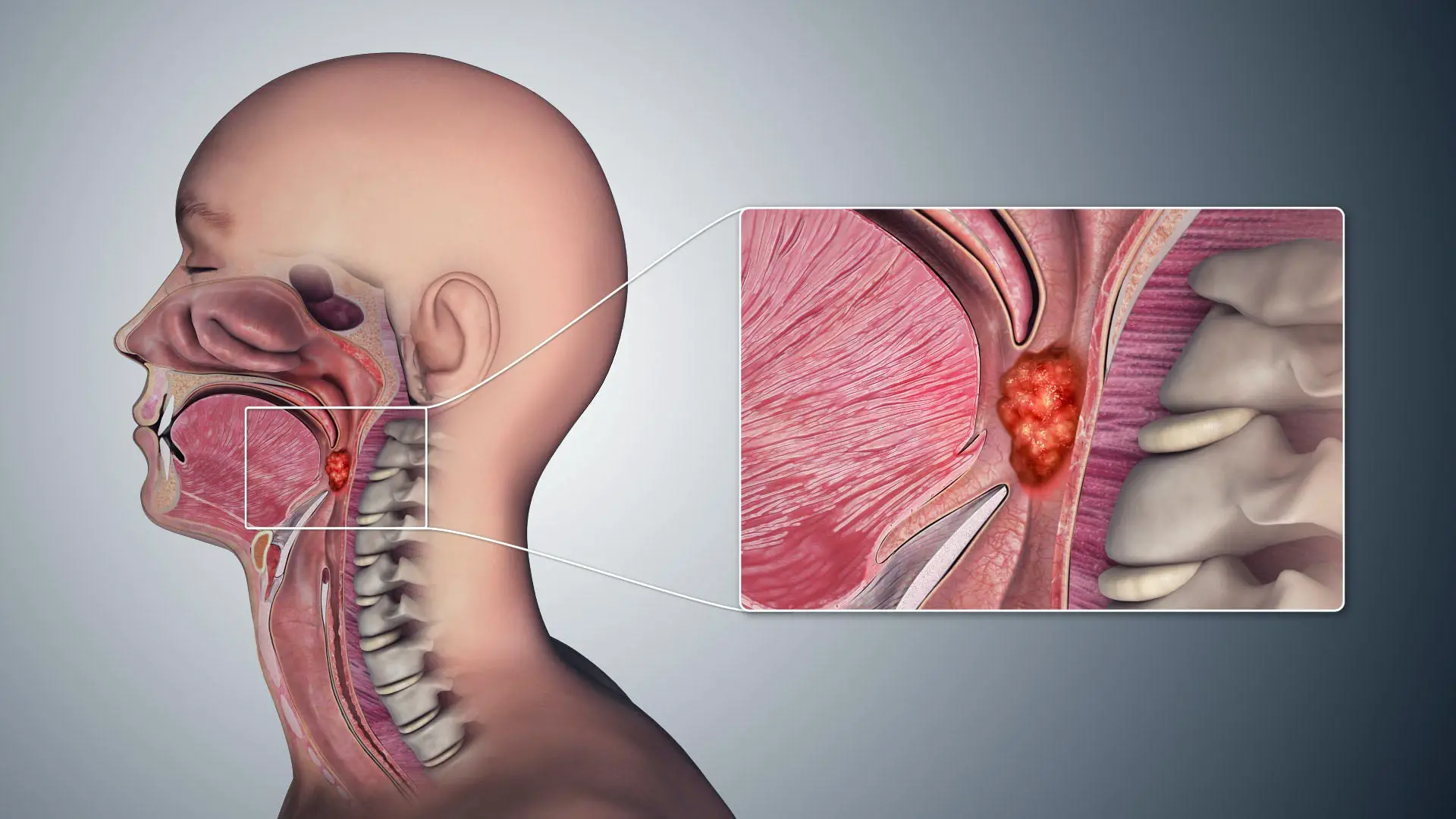 Featured image for The Rise of Throat Cancer: The Link to Oral Sex