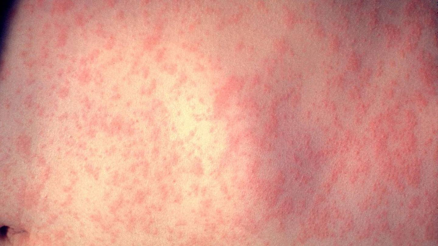 Measles Exposure at Busy Kroger Prompts Health Alert
