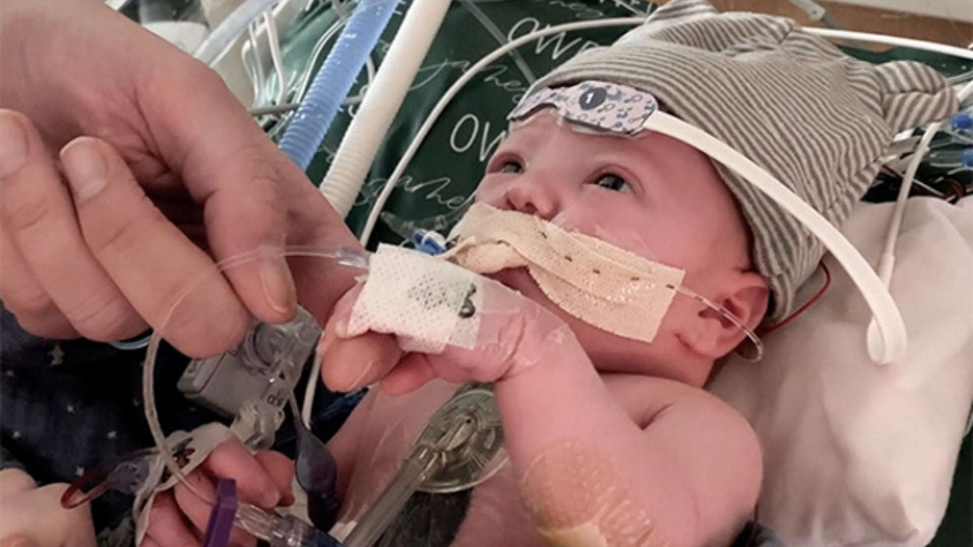 Featured image for "Infant Thrives After Groundbreaking Partial Heart Transplant Marks First Successful Year"