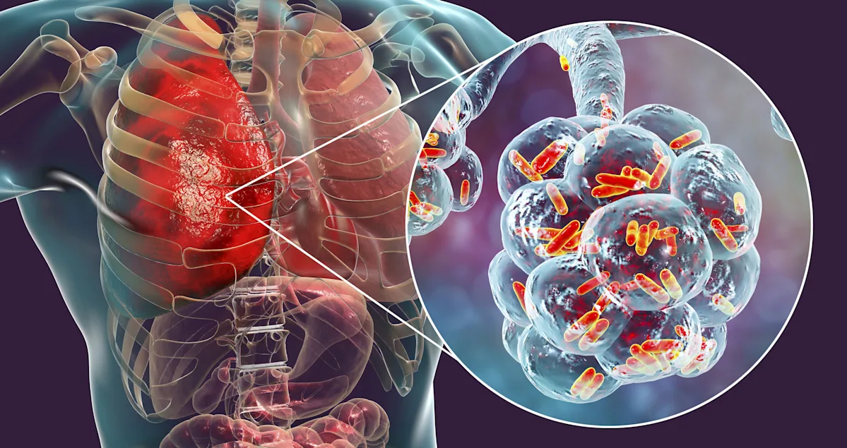 Featured image for NYC Legionnaires' Outbreak: 3 Dead, Dozens Sickened in Harlem Cluster