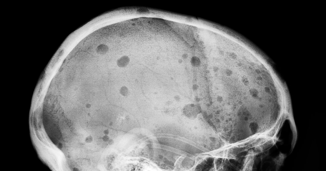 Featured image for Breakthroughs in CAR-T Therapy Offer Hope for Multiple Myeloma Patients