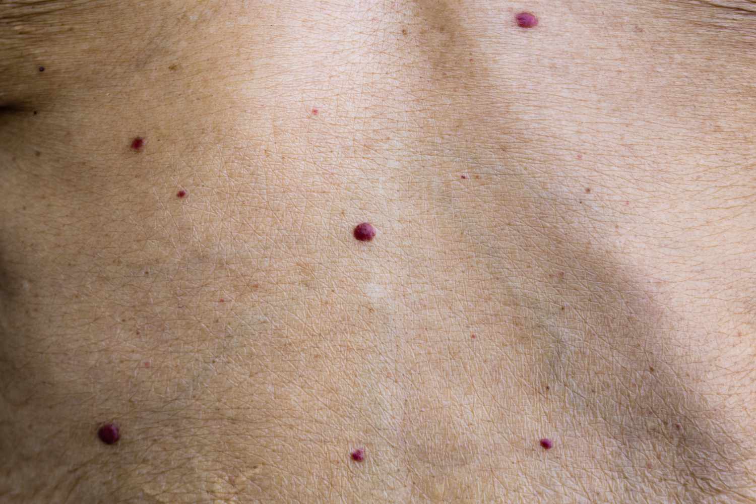 Featured image for "Spotting Red Moles: Recognizing Sudden Signs of Cherry Angiomas"