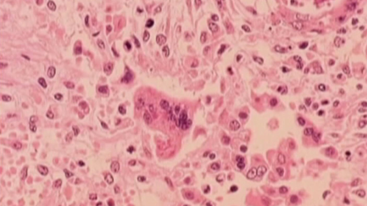 Featured image for Health Officials Warn of Measles Exposure at Philadelphia Airport