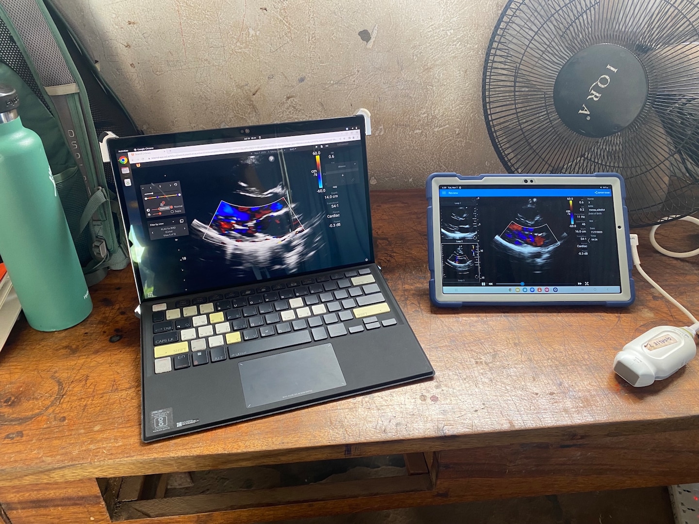 Featured image for "AI Tool Revolutionizes Rheumatic Heart Disease Screening for Children"