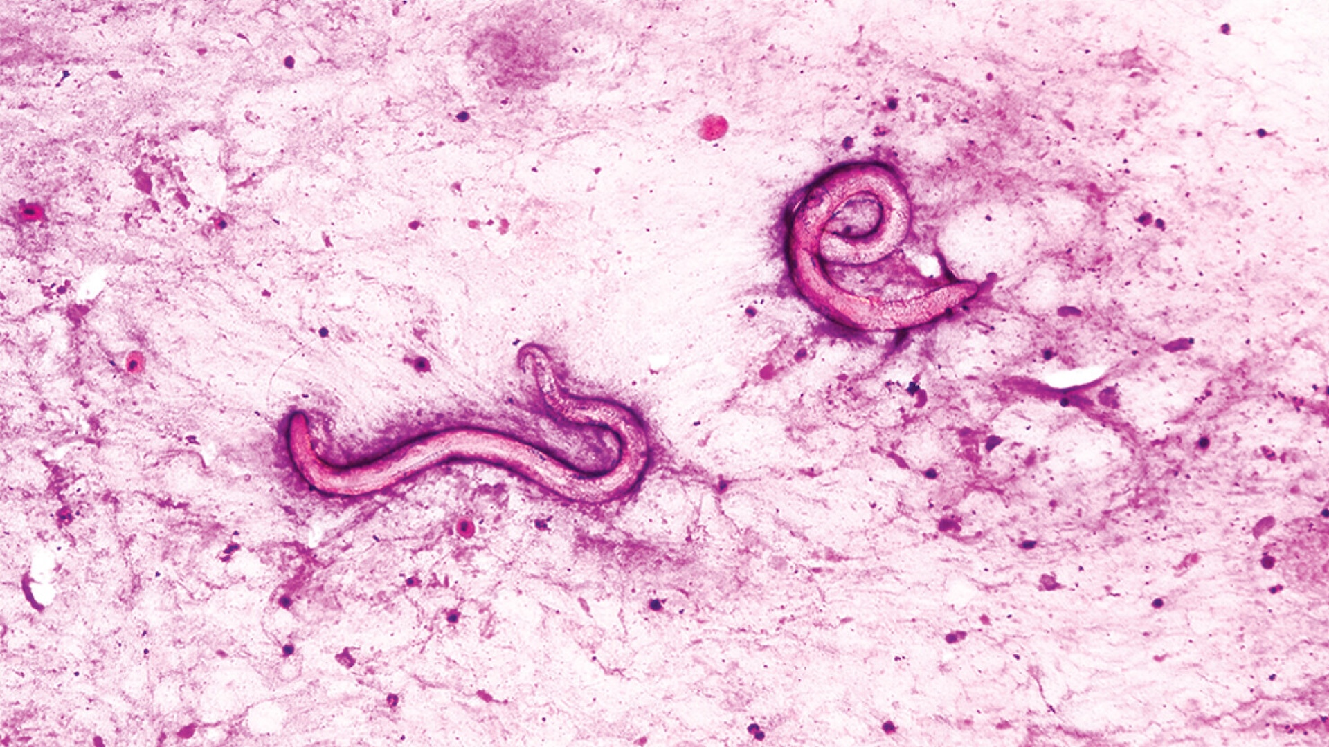 Featured image for Man develops parasitic worms after kidney transplant at US hospital