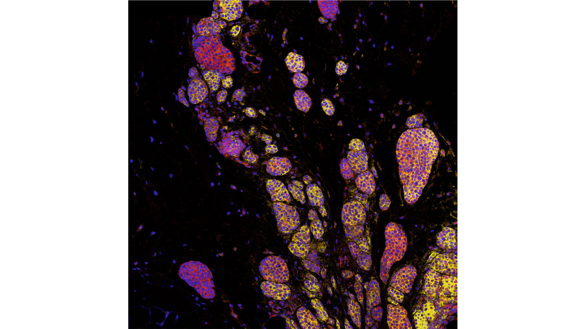 Featured image for "Revolutionary Fecal Transplants Enhance Melanoma Treatment"