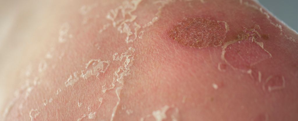 Featured image for Breakthrough Cure Achieved for Rare Fatal Skin Disease