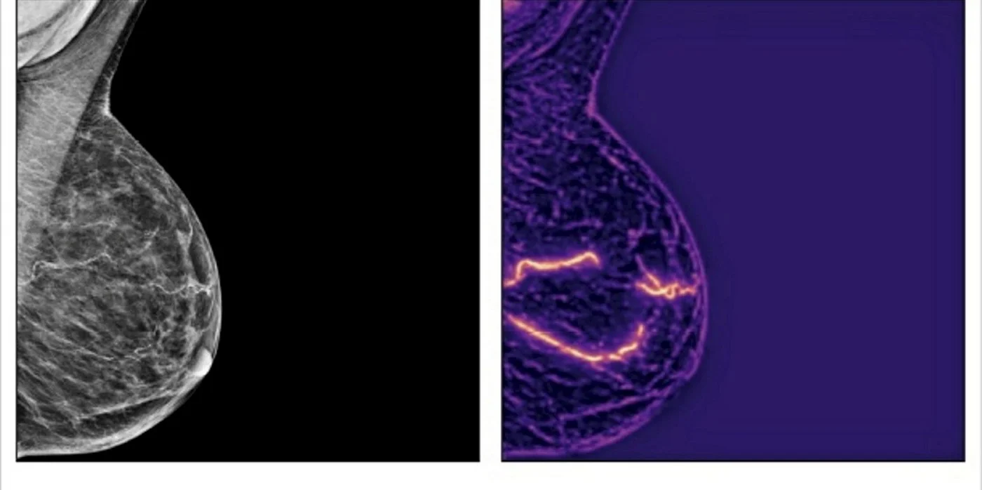 AI Finds Heart-Disease Clues in Routine Mammograms, Increasing Risk Estimates by Up to 70%
