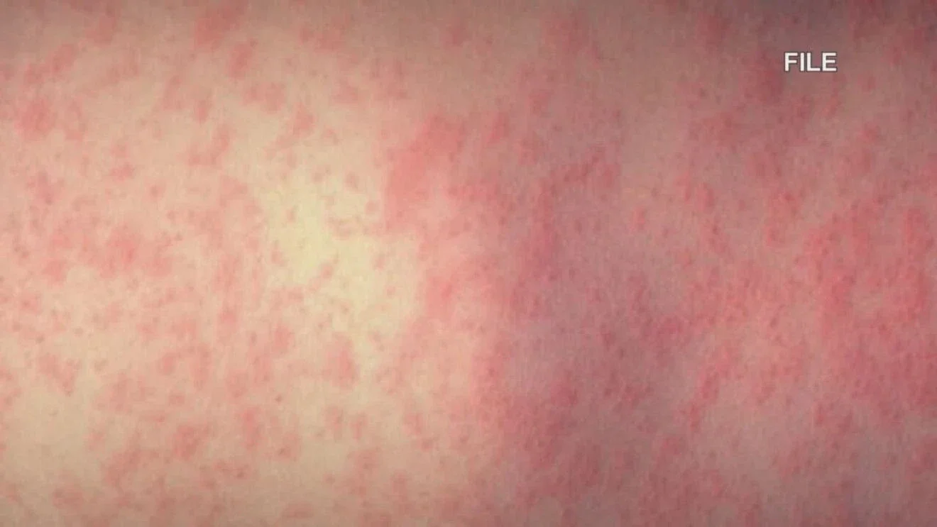 Clark County logs six new measles cases tied to Ridgefield High School