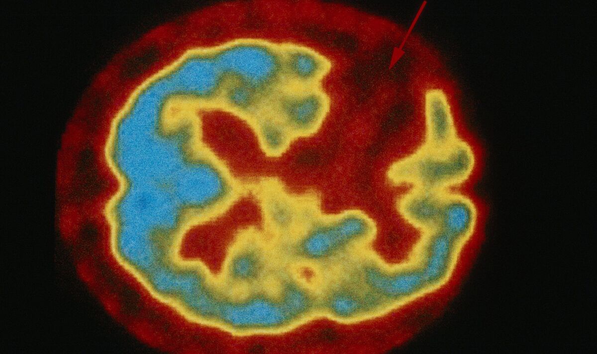 Featured image for Global Stroke Deaths Expected to Triple by 2030, Warns Report