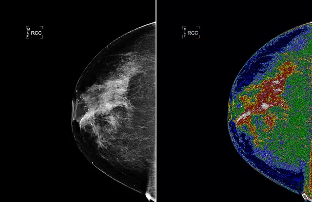 Promising Results: Breakthrough Breast Cancer Vaccine Shows Good Response in Clinical Trials