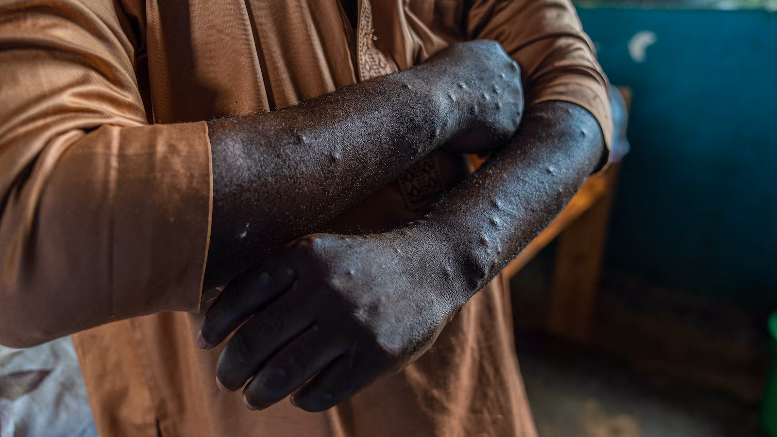 CDC Alerts Doctors as First Aggressive Mpox Strain Hits U.S.
