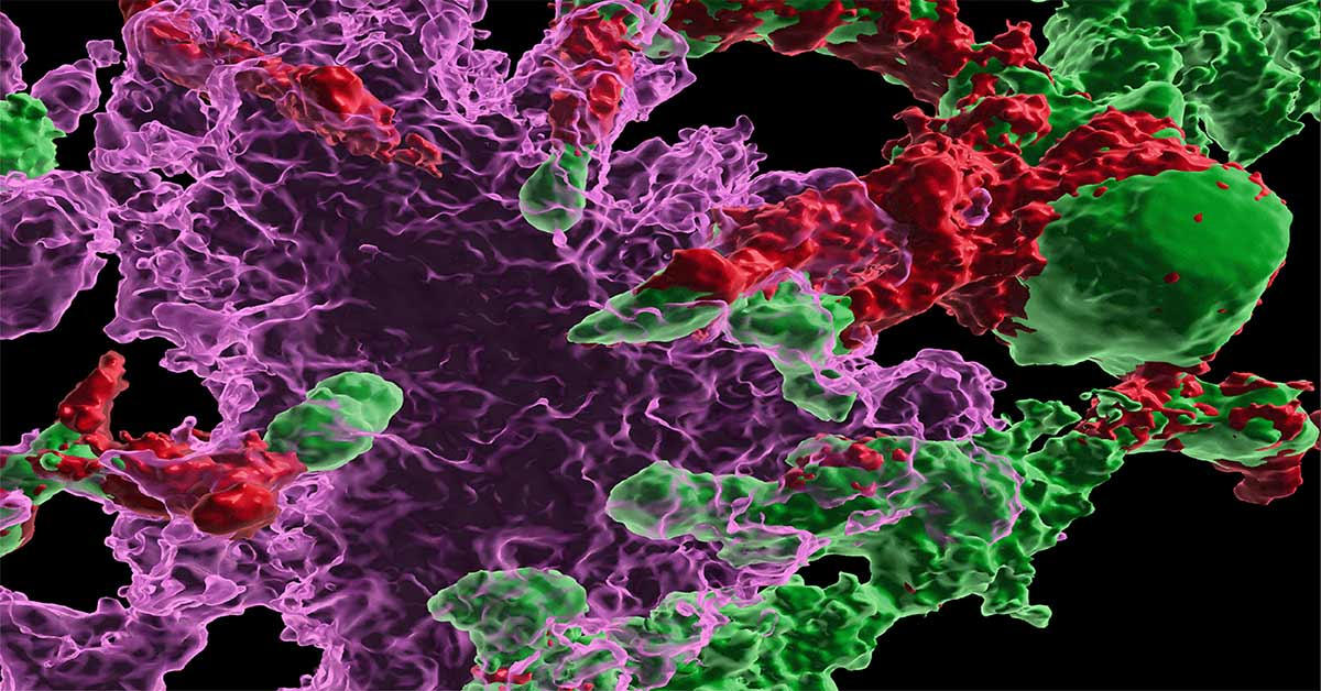 Stem Cell Therapy Offers Hope in Reversing Alzheimer's