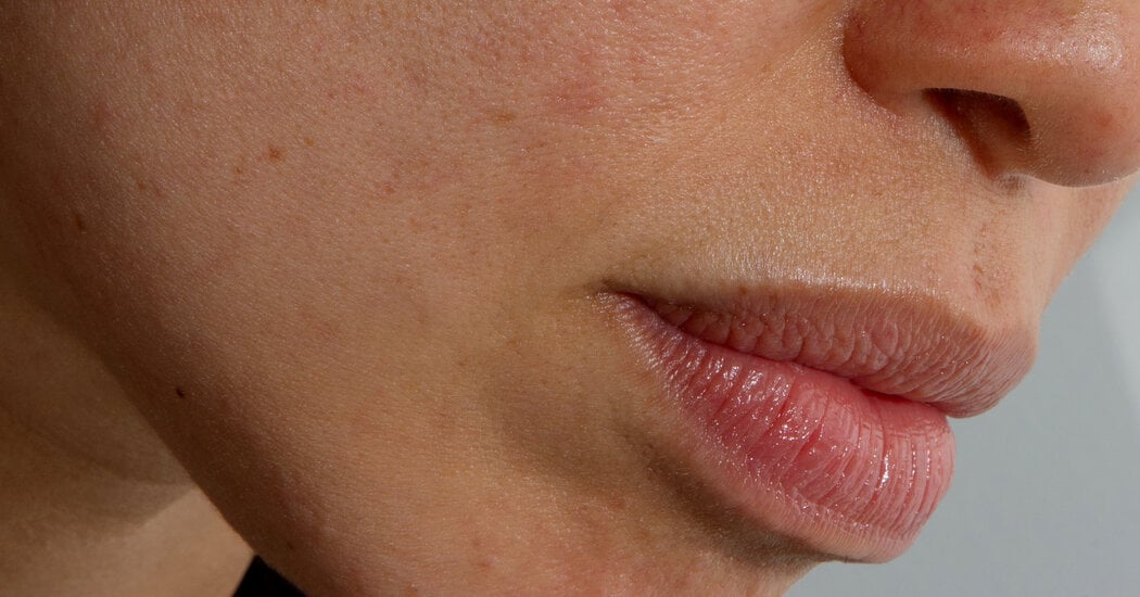 Featured image for Aging and Skin Changes: Unraveling the Connection to Rosacea Worsening