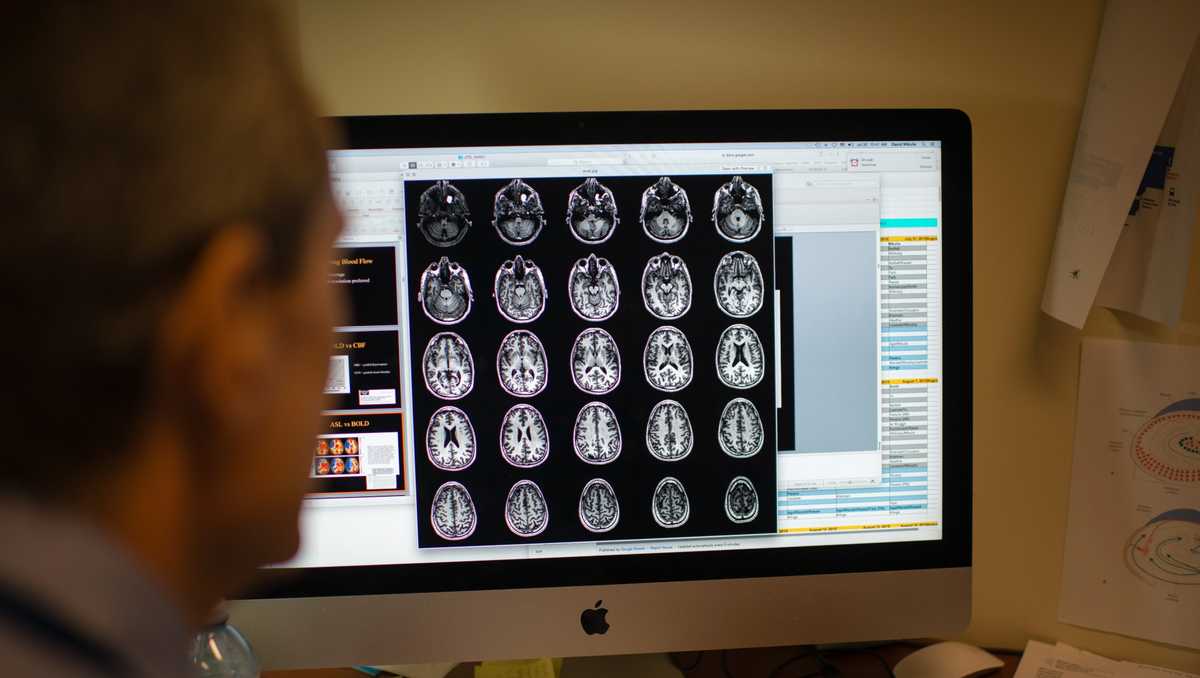 "Preceding Alzheimer's: Uncovering Silent Brain Changes"