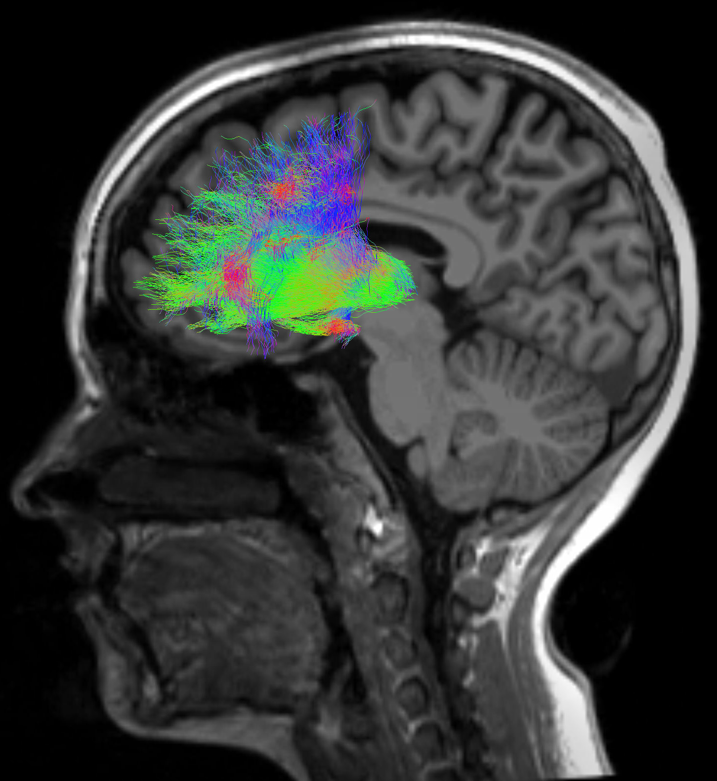 Featured image for Exploring Brain Activity and Cognitive Challenges in Schizophrenia