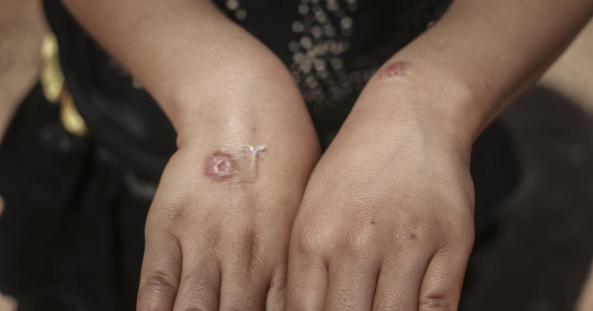 Featured image for Emerging Tropical Parasite Epidemic Hits U.S., Particularly Texas