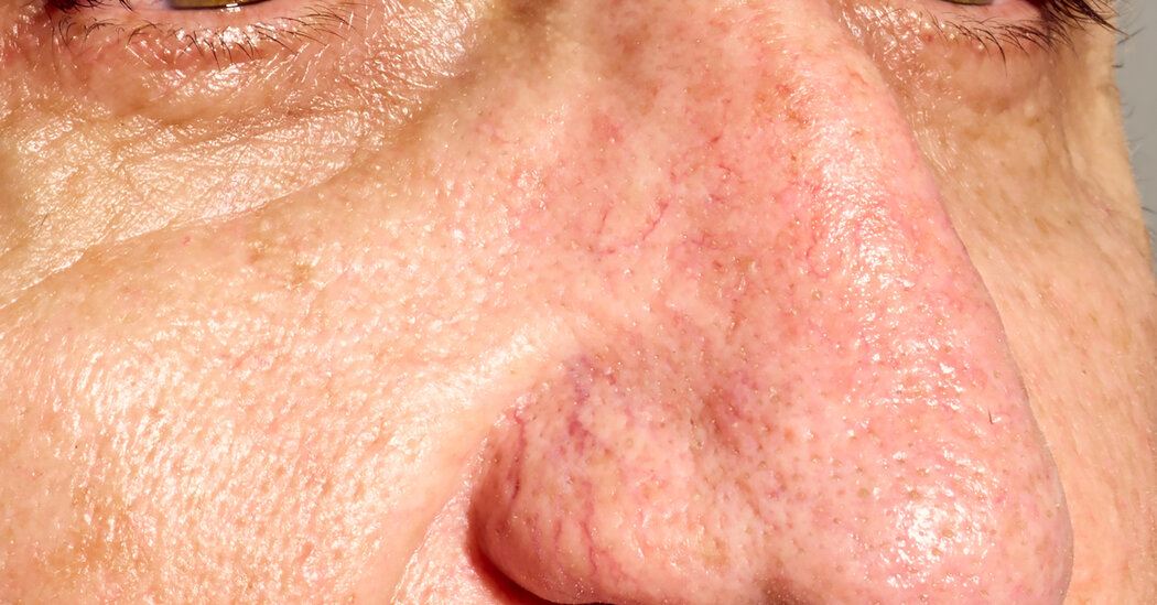 Featured image for "Effective Solutions for Facial Spider Veins"