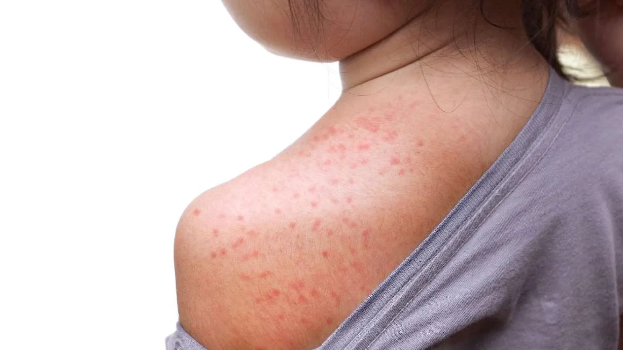 Measles Outbreak Expands in Washington County Schools