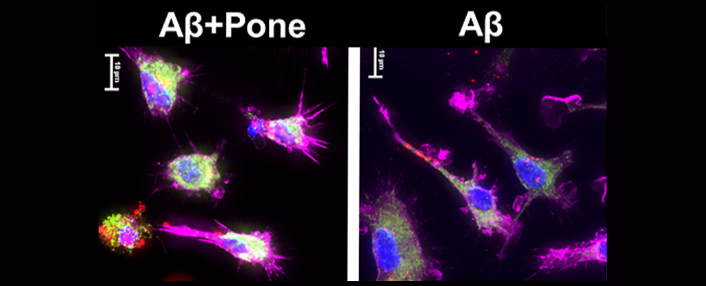 "MS Drug Holds Potential as Alzheimer's Treatment, Scientists Find"
