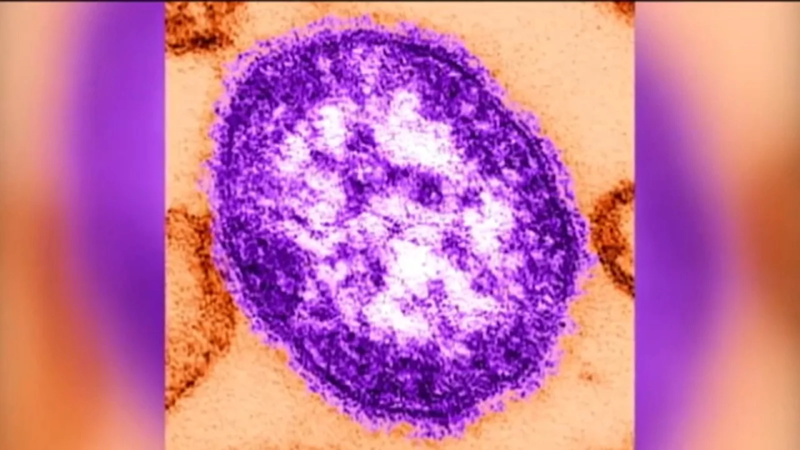 Measles exposure possible in Collegeville prompts 21-day symptom monitoring