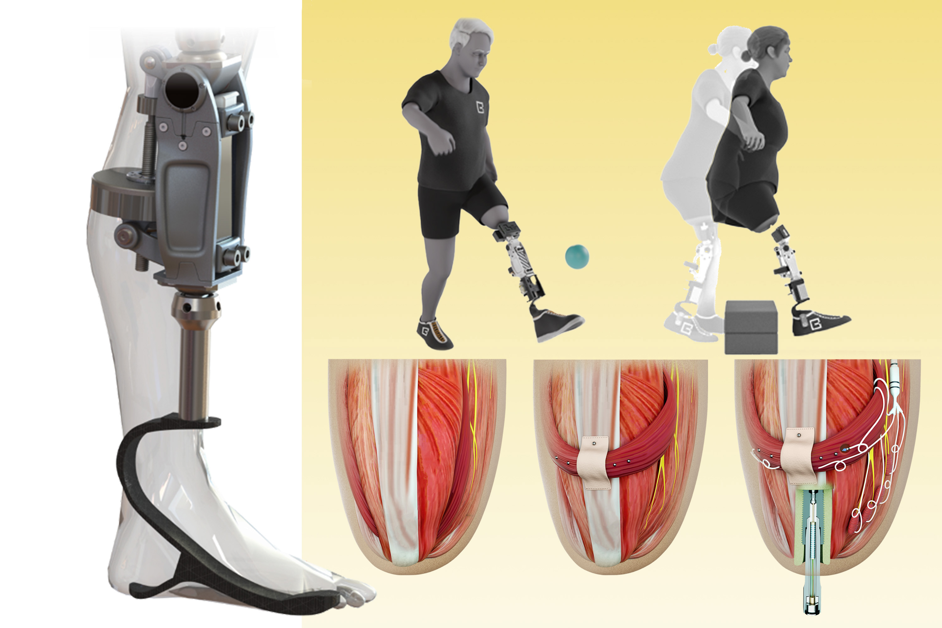 Featured image for Innovative Bionic Knee and Leg Technologies Enhance Mobility for Amputees